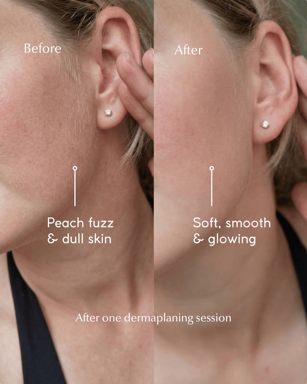 Before and after of peach fuzz removal using dermaplaning tool on an Australian women's cheek area.