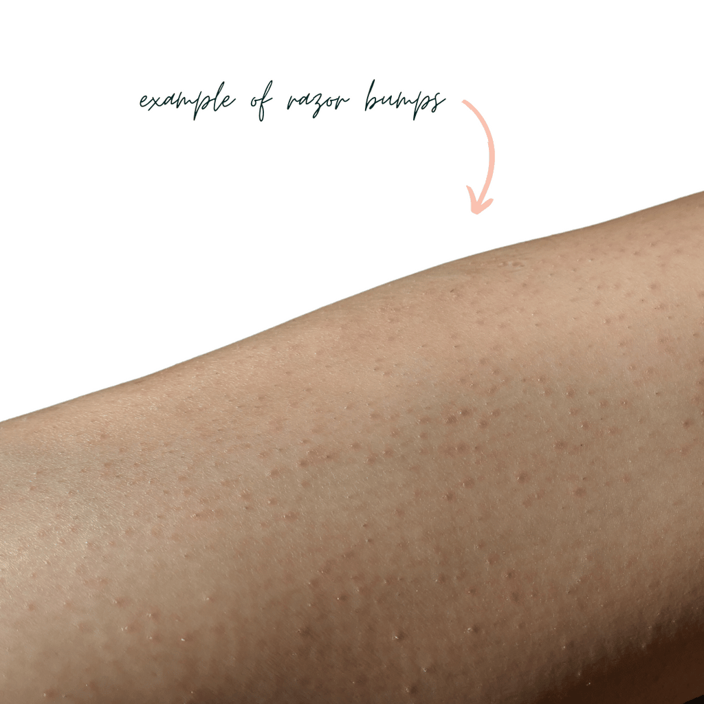 How To Get Rid Of Razor Bumps.on Legs at Roscoe Ramirez blog