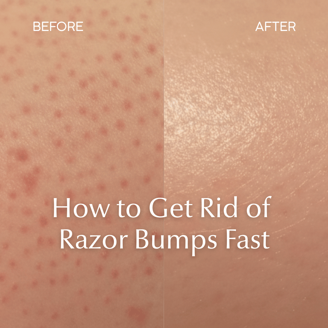 How to Get Rid of Razor Bumps Fast 